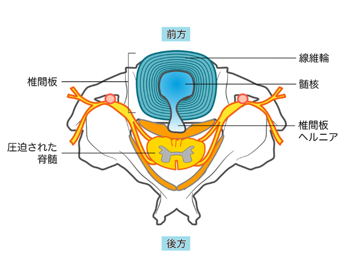 ヘルニア図2