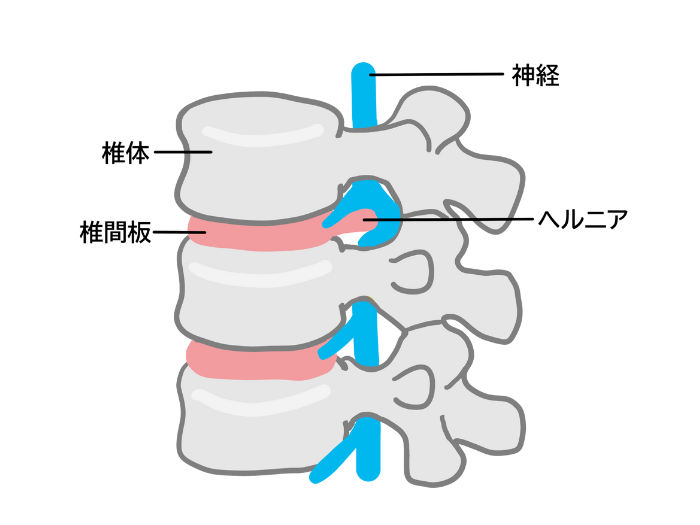 ヘルニア図1