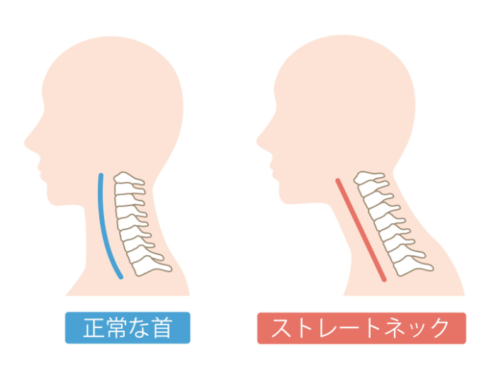 ストレートネック比較